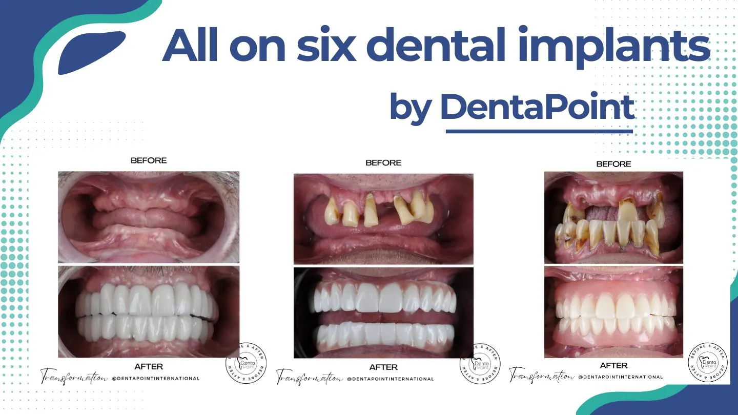 All on six dental implants before and after